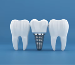 Dental Implants