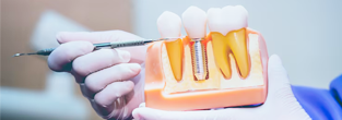 Dental Implants
